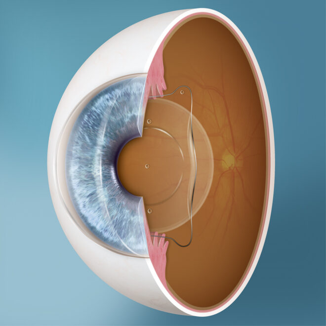 Cross Section of Eye with EVO vertical 1