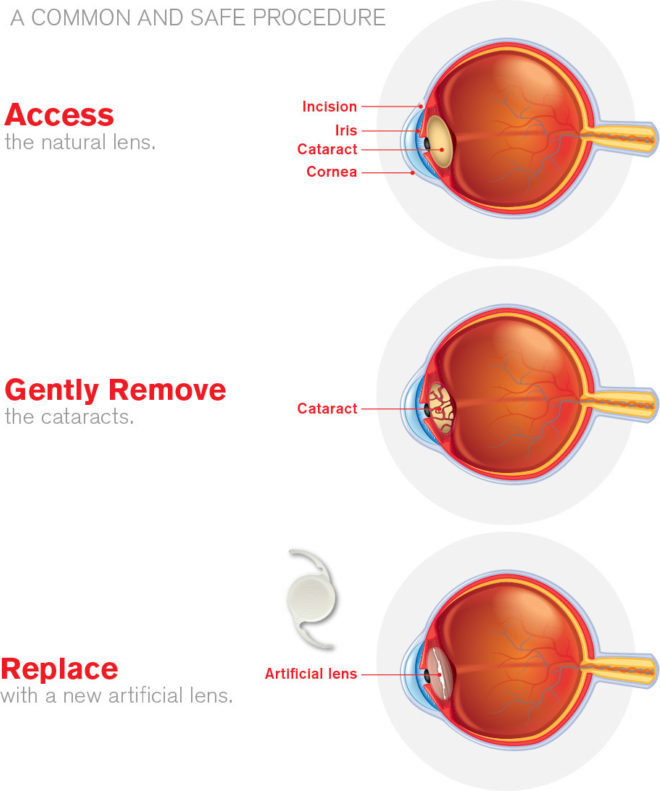 Cataract Surgery Process Image 04